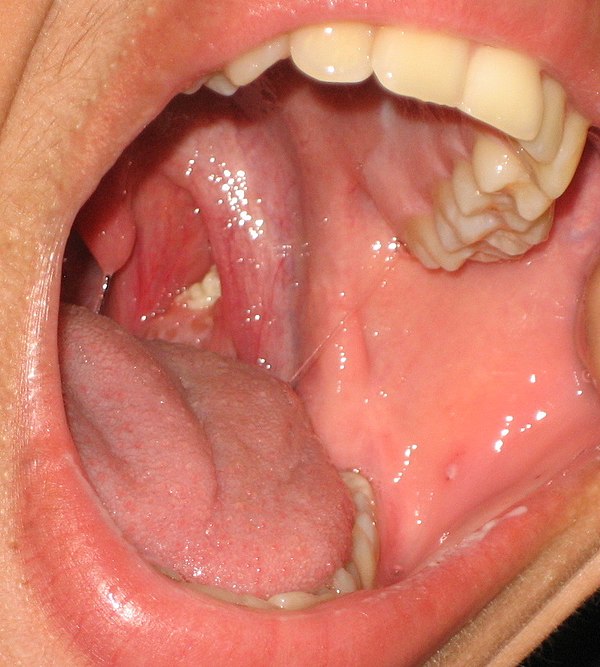 Tonsil Stone: How To Check For Tonsil Stones