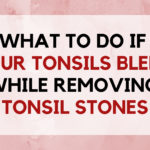 What To Do If Your Tonsils Bleed